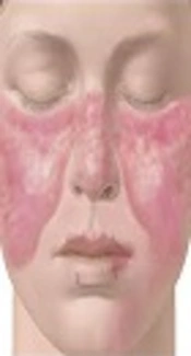 Association Study of the <i>PTPN22 </i>Gene Polymorphisms with Systemic Lupus Erythematosus in Lorestan Province of Iran
